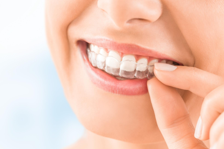 Guelph Dentist Invisible Braces