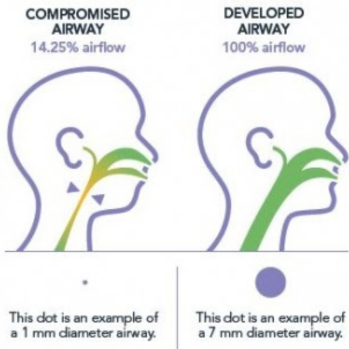 Compromised vs Developed Airway
