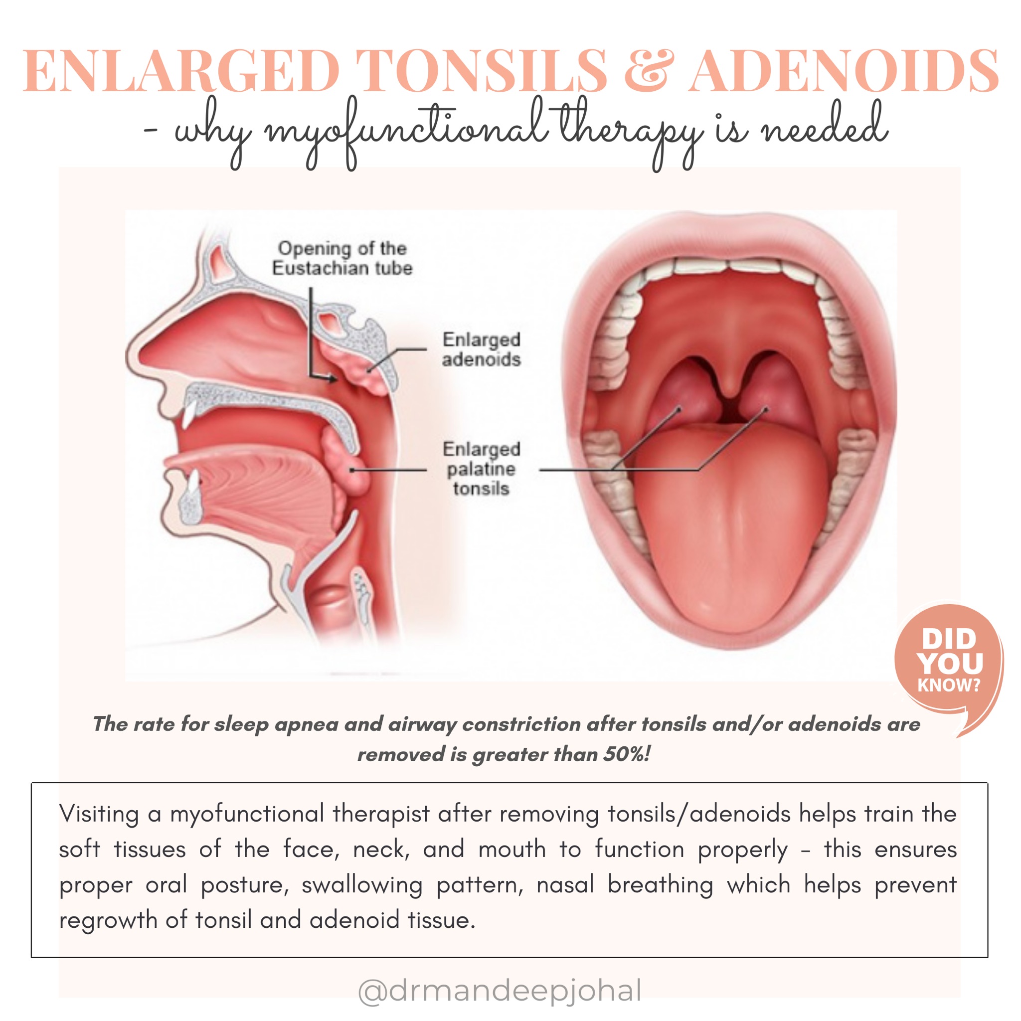 adenoidectomy before and after