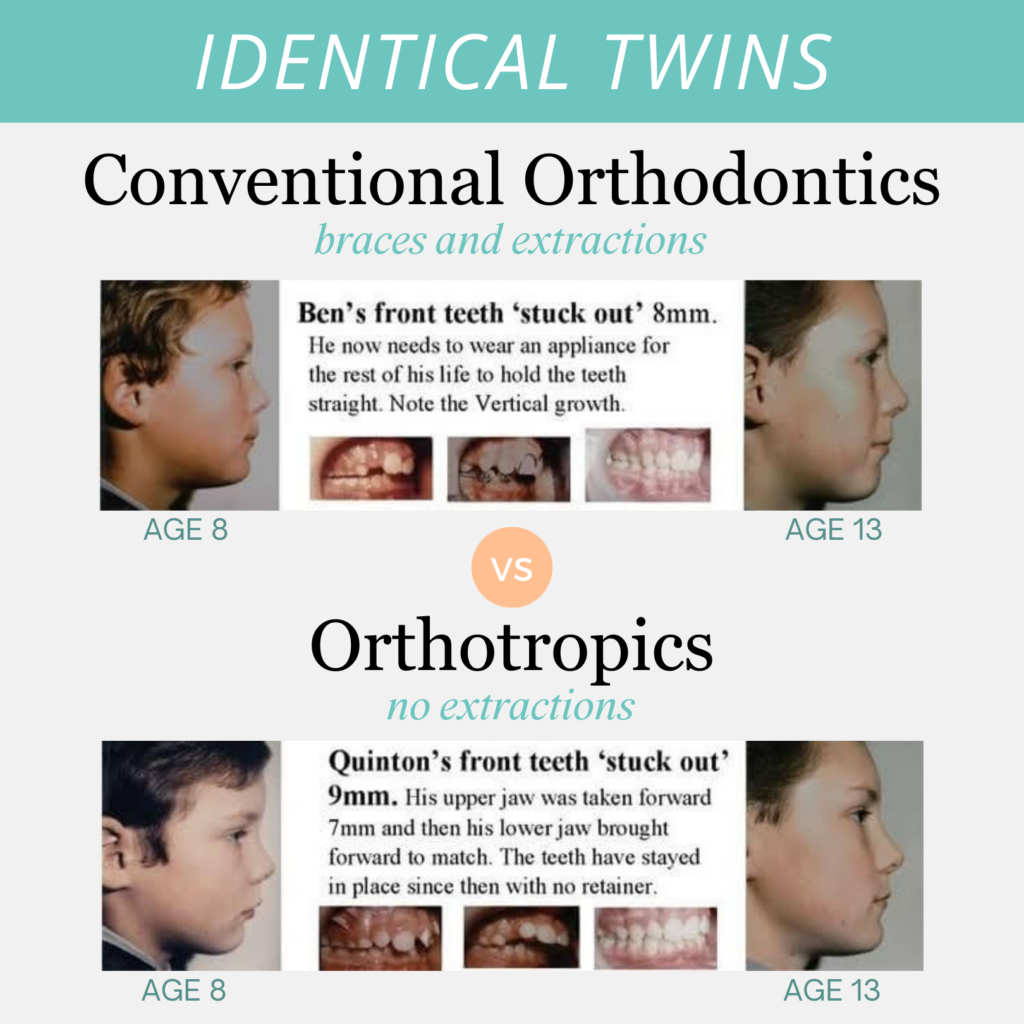 Mewing Before and After Identical Twins Case Study